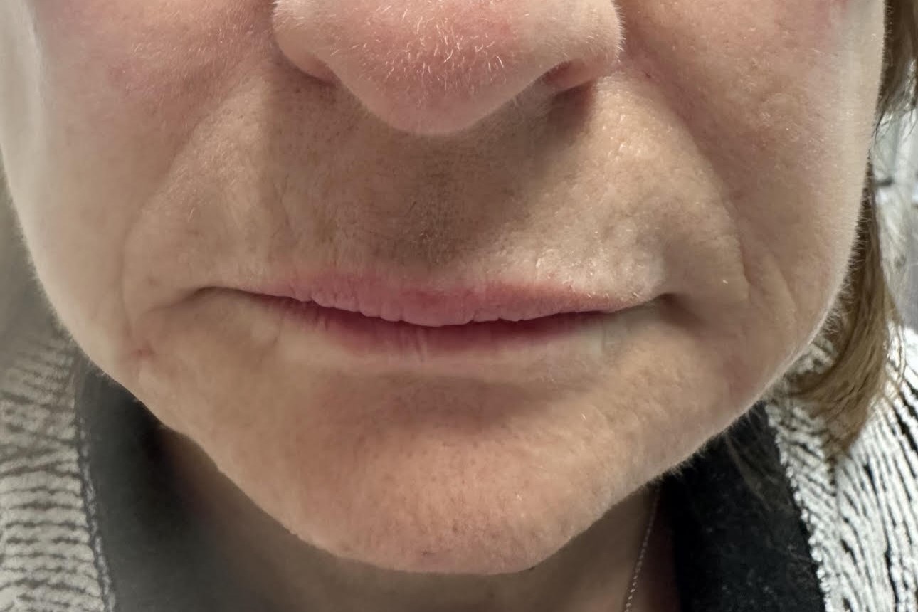 Chin Enhancement — after