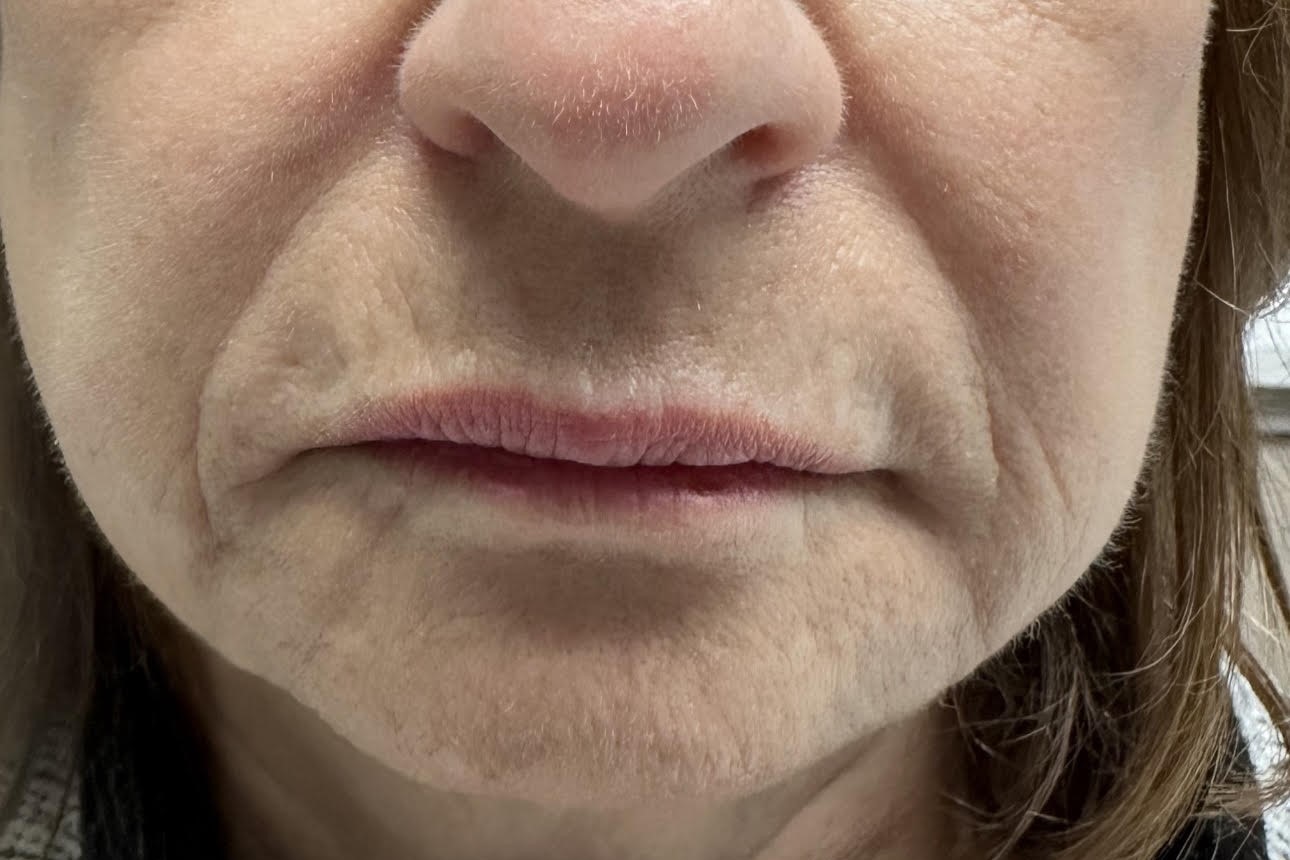 Chin Enhancement — before