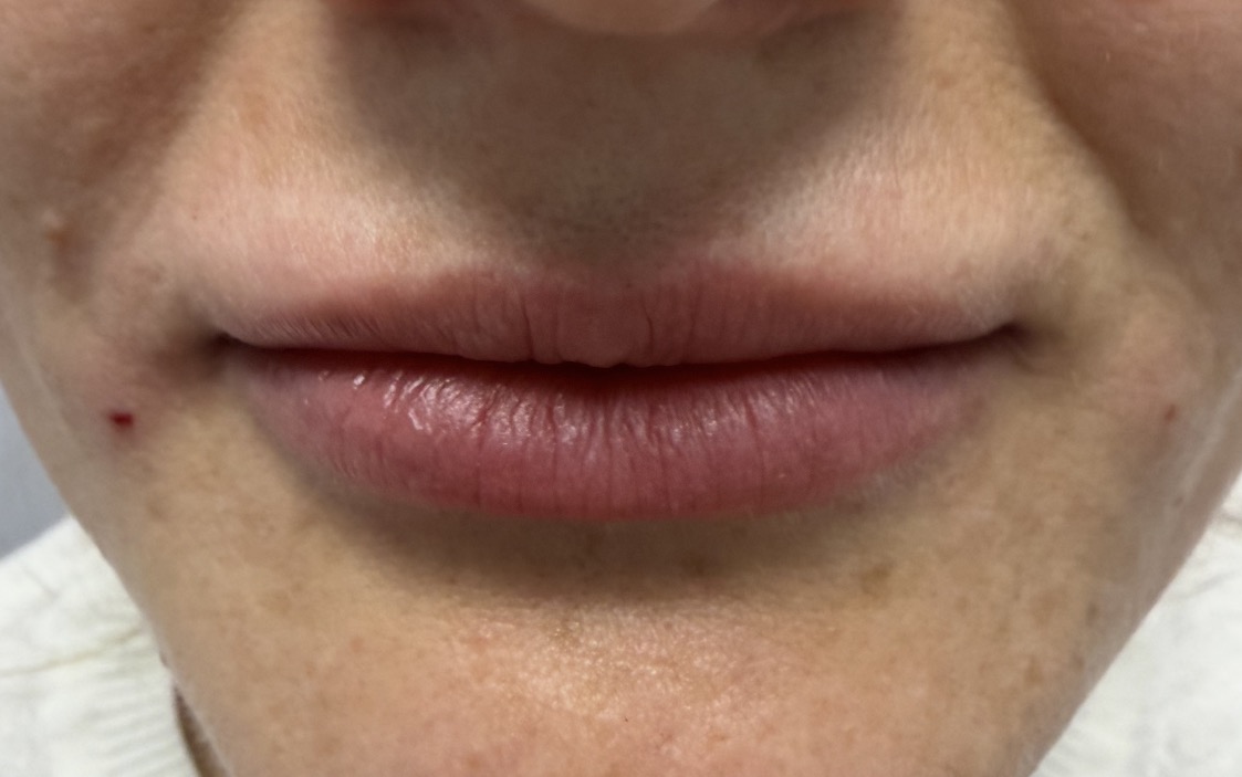 EZ-Gel for Lips — after treatment