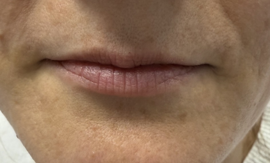 EZ-Gel for Lips — before treatment