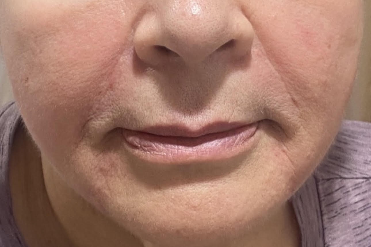 Face Rejuvenation — after