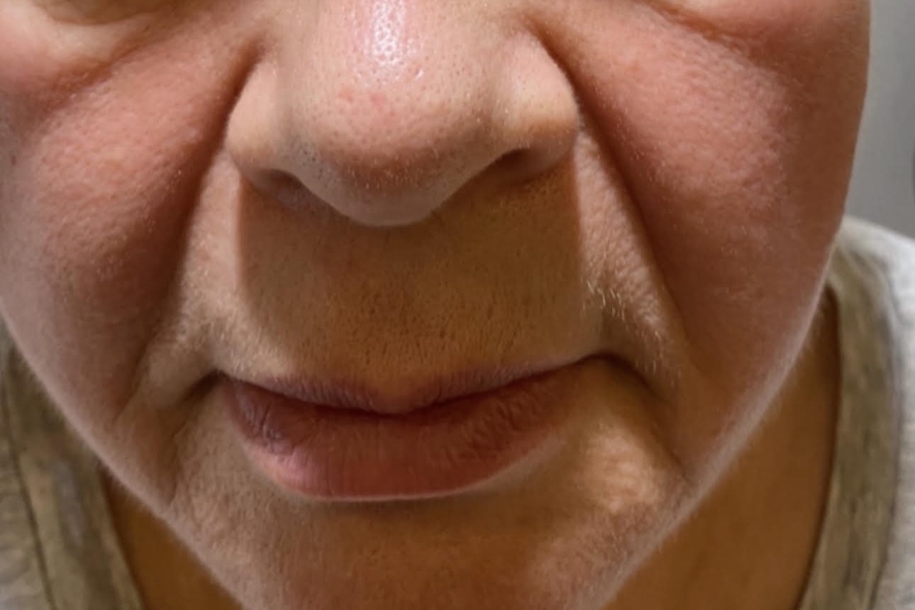 Face Rejuvenation — before