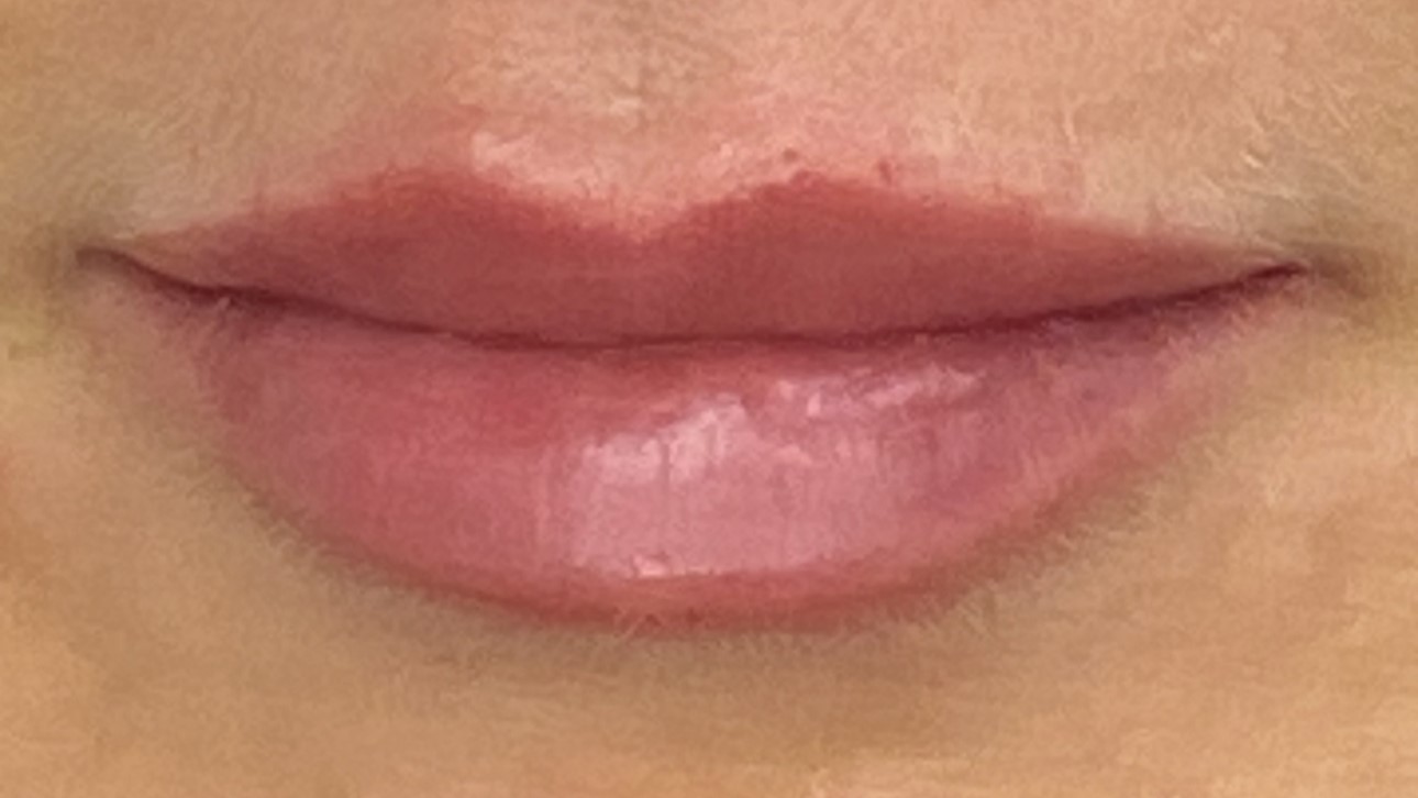 Lip Enhancement — after