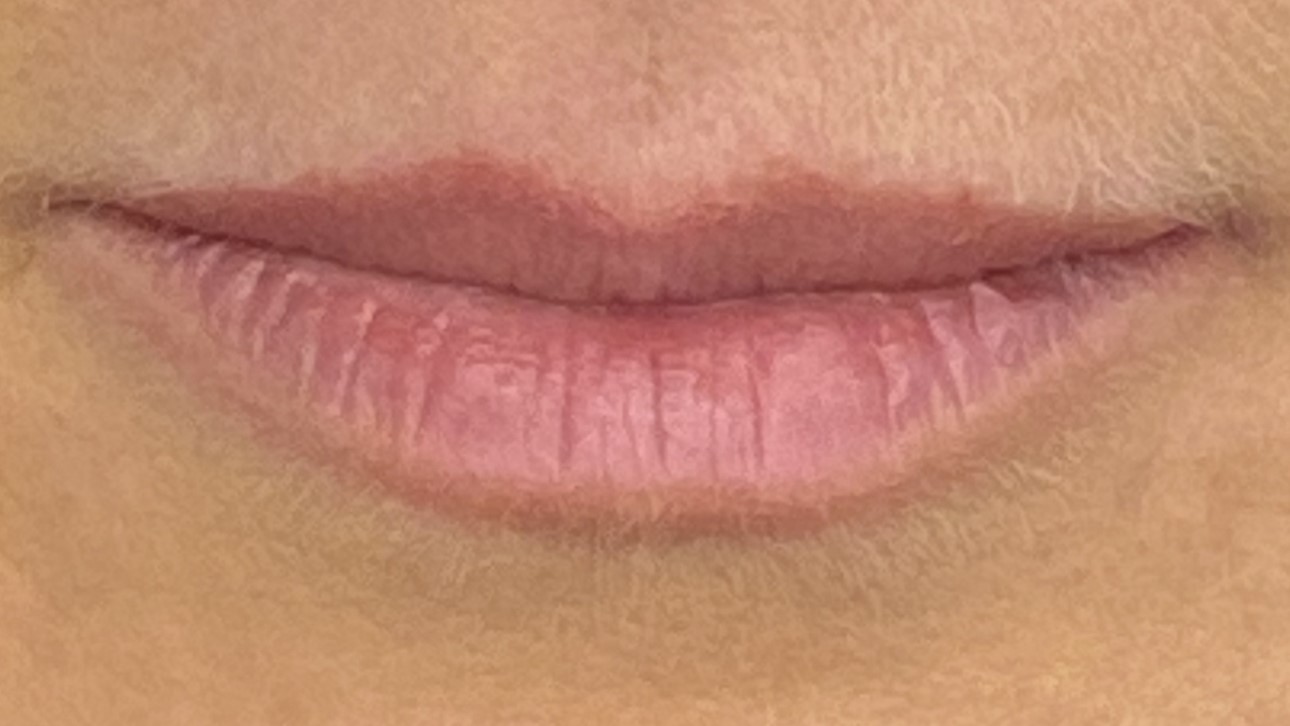 Lip Enhancement — before