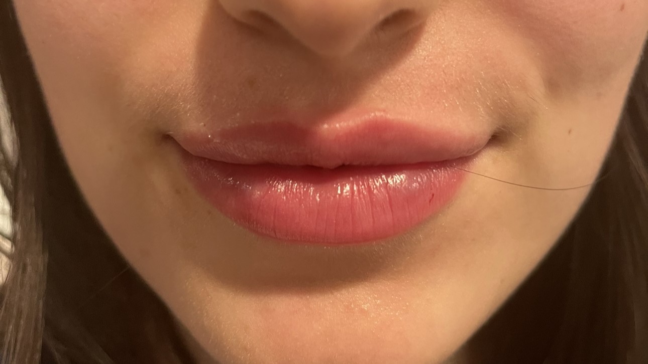 Lip Enhancement — after