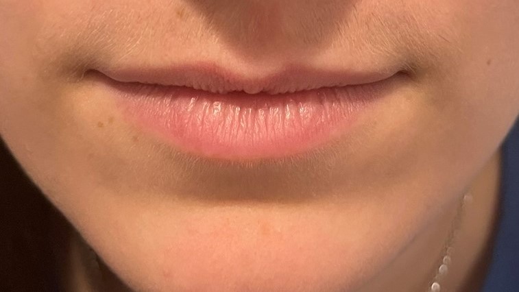 Lip Enhancement — before