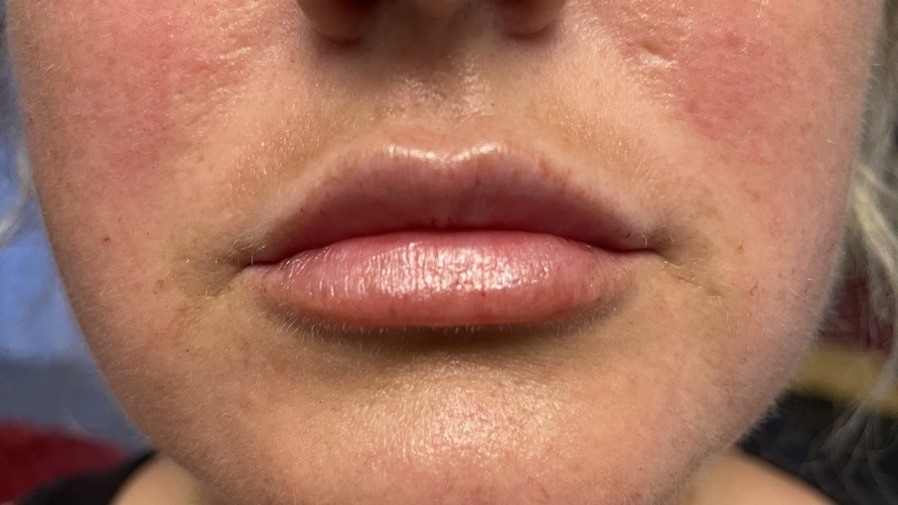Lip Enhancement — after