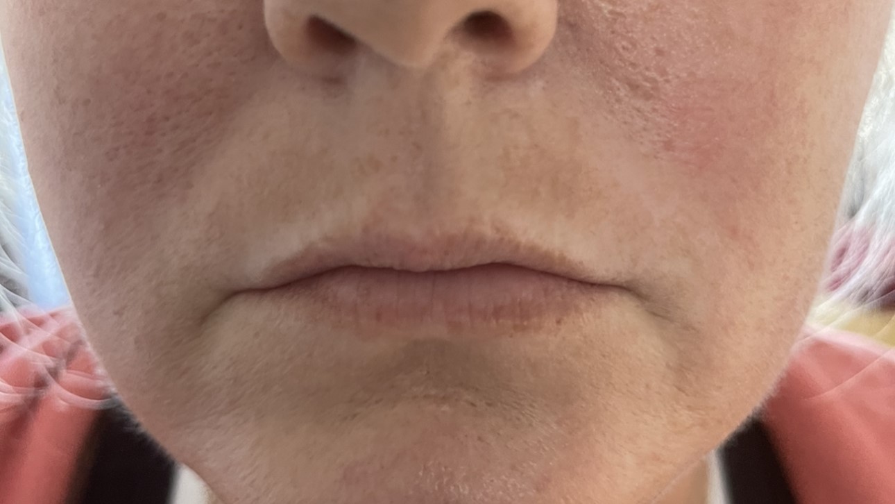 Lip Enhancement — before