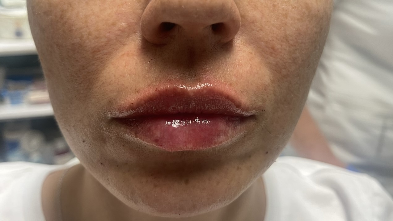 Lip Enhancement — after