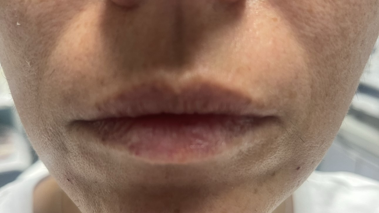 Lip Enhancement — before