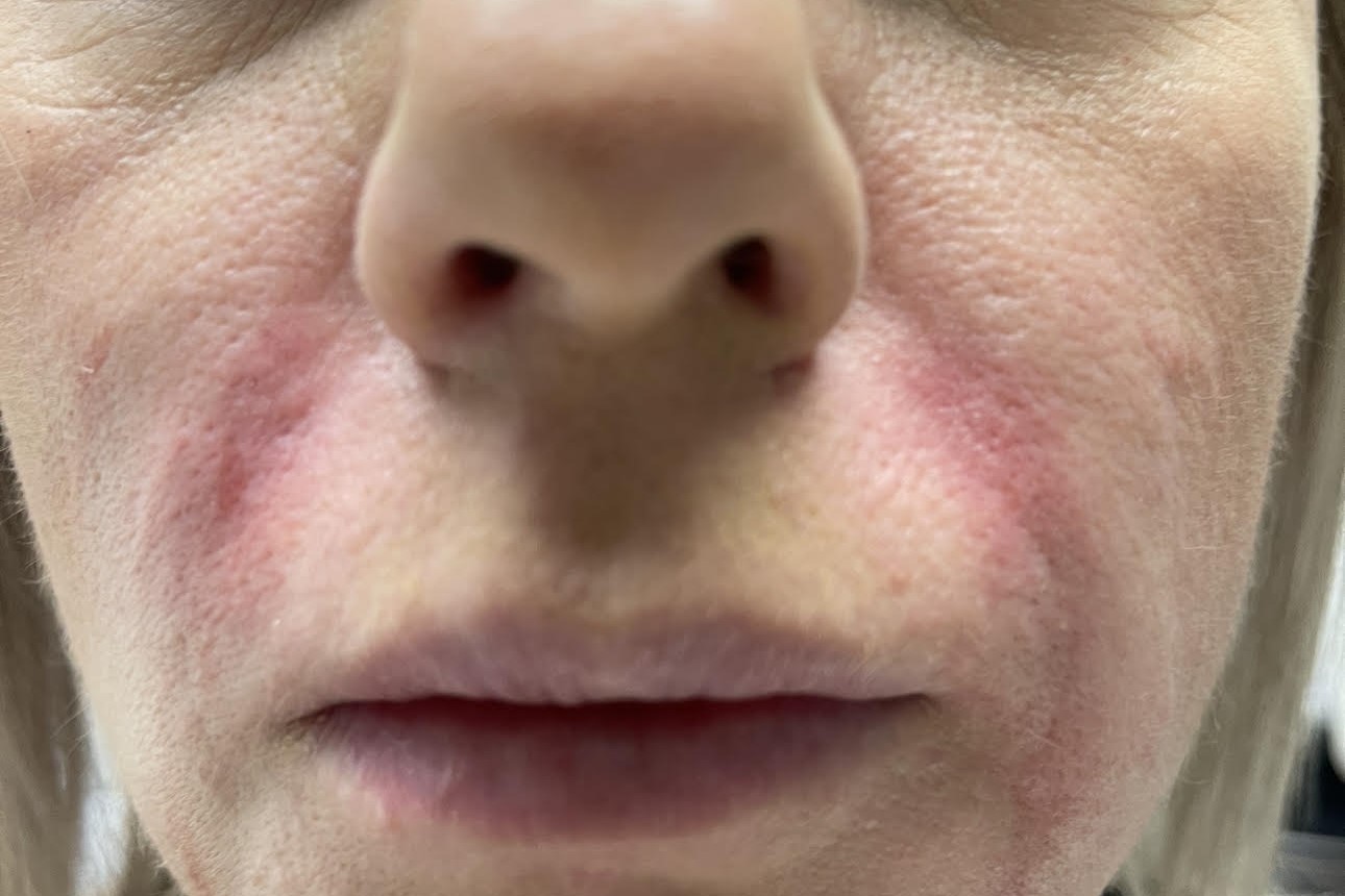Nasolabial Folds — after