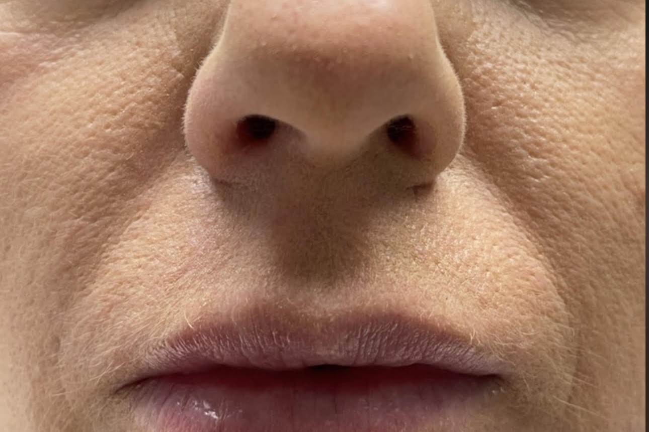 Nasolabial Folds — before